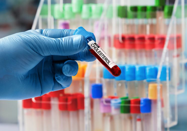 cholesterol blood test