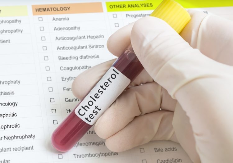 cholesterol test in Wallington