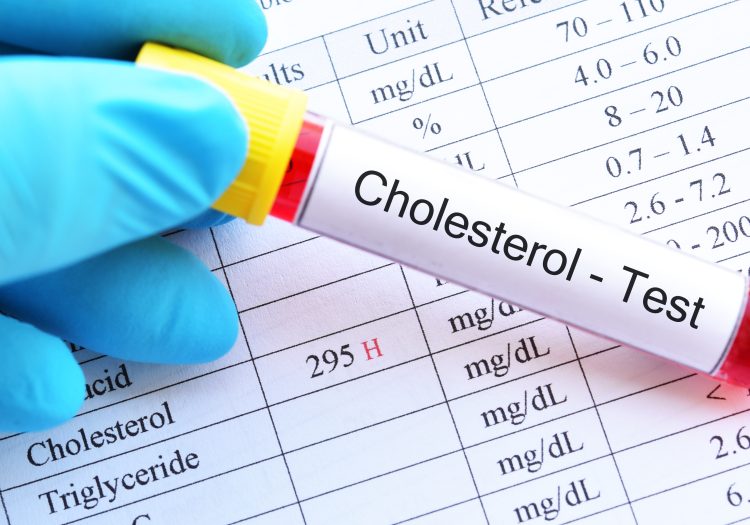 cholesterol blood test in Croydon